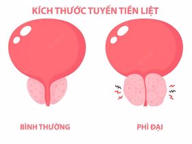 Phì đại tuyến tiền liệt nên ăn gì - Chuyên gia giải đáp!